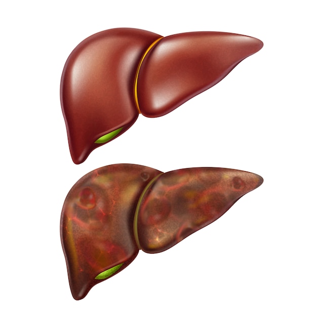Conjunto de órganos sanos y no saludables para el hígado humano