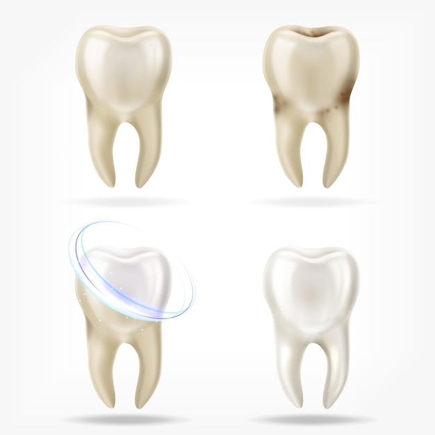 Conjunto de vector de diente limpio y sucio realista 3d, proceso de limpieza del diente.