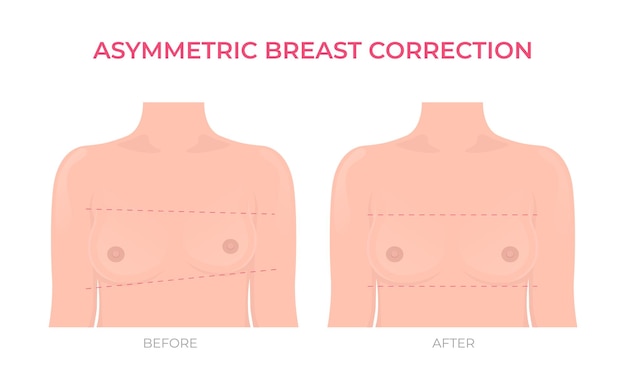 Vector corrección asimétrica de senos antes y después de la vista frontal de la cirugía plástica