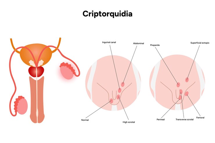 Vector criptorquidia enfermedad testicular hombre cryptorchidismo dolor problema de patología de los testículos