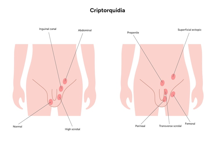 Vector criptorquidia enfermedad testicular hombre cryptorchidismo dolor problema de patología de los testículos