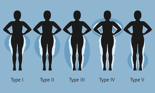 Vector el cuerpo de la mujer en diferentes tipos de lipedema