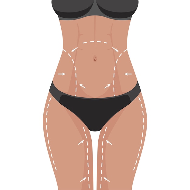 Cuerpo perfecto para adelgazar liposucción para perder peso.