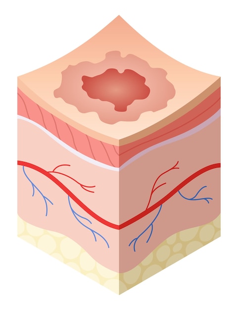 Cuidado de la piel concepto médico Problemas en la sección transversal de la piel humana estructura de capas horizontales modelo ilustrativo de anatomía capa no saludable de la piel