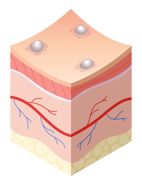 Vector cuidado de la piel concepto médico problemas en la sección transversal de la piel humana estructura de capas horizontales modelo ilustrativo de anatomía capa no saludable de la piel