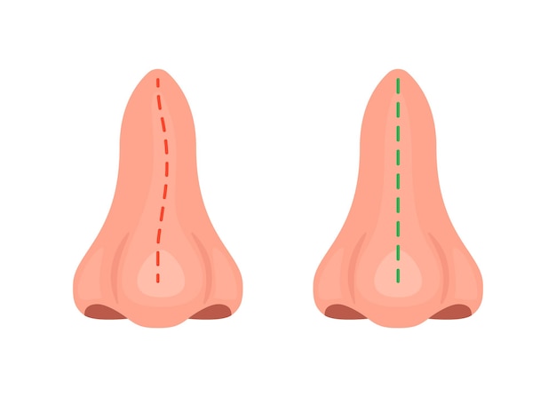 Vector curva y corrección de la nariz cirugía de curvatura nasal rinoplastia antes y después del tratamiento