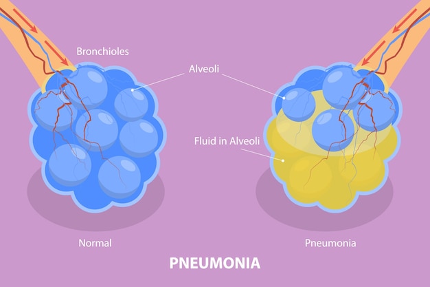 Vector d ilustración vectorial plana isométrica de infección pulmonar por neumonía