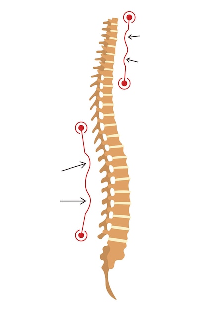 Vector deformidad de la columna símbolo de curvaturas de la columna vertebral o columna vertebral no saludable anatomía de la columna vertebral humana columna curvada diagrama con sección marcada defecto de la postura del cuerpo