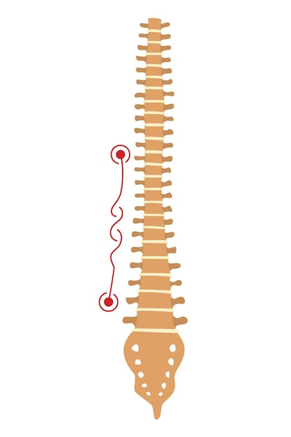 Deformidad de la columna Símbolo de curvaturas de la columna vertebral o columna vertebral no saludable Anatomía de la columna vertebral humana columna curvada Diagrama con sección marcada Defecto de la postura del cuerpo