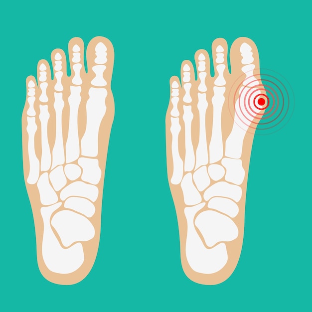 Vector deformidad valgus del dedo gordo del pie cuidado de la salud del pie ilustraciones vectoriales