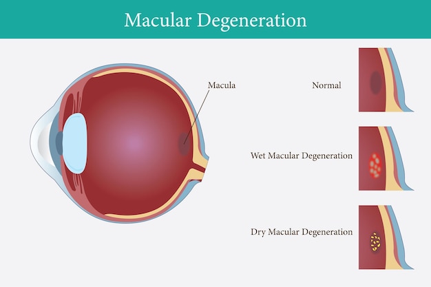 Vector degeneración macular relacionada con la edad vector de trastorno de la visión ocular eps 10