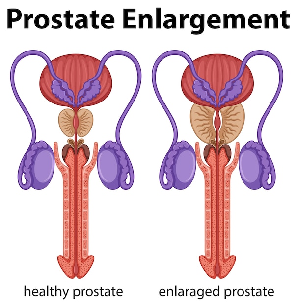 Vector dentro del sistema reproductor masculino con agrandamiento de la próstata