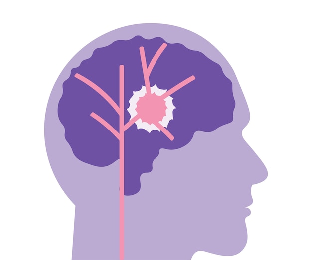 El derrame cerebral