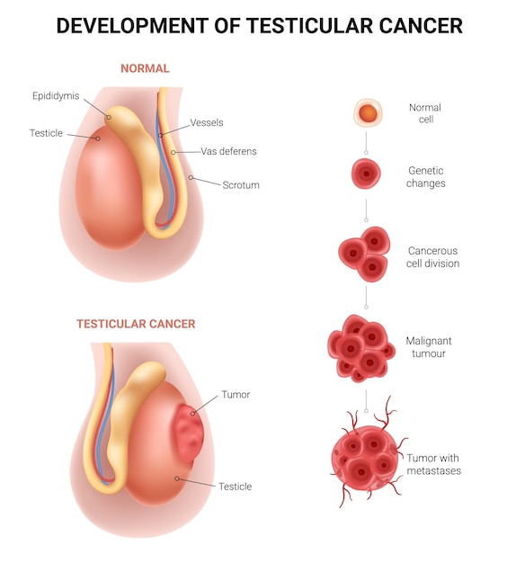 Development of testicular cancer: a visual guide