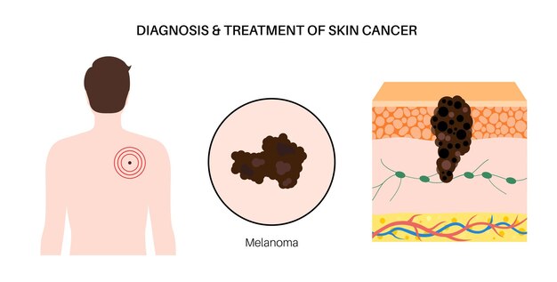 Vector diagnóstico de cáncer de piel