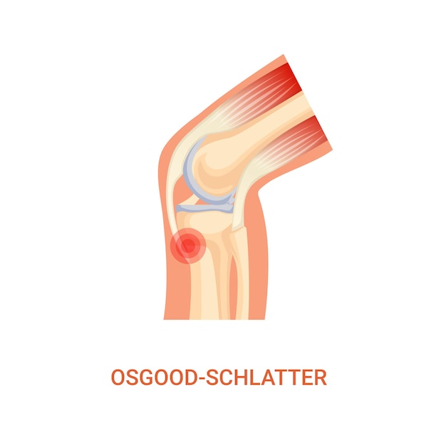 Diagnóstico de la enfermedad de Osgood Schlatter