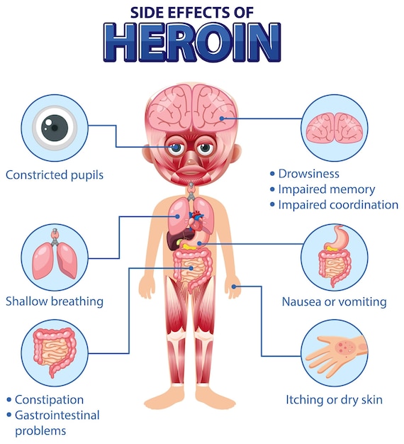 Diagrama de anatomía humana estilo de dibujos animados de los efectos secundarios de la heroína