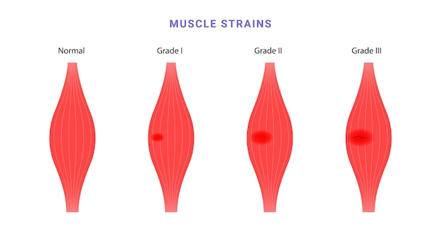Diagrama científico de clasificación de la tensión muscular