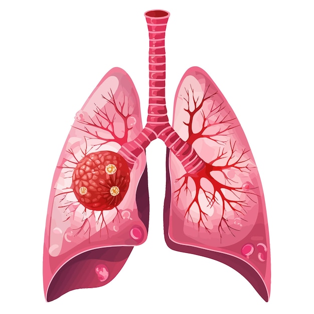 Diagrama_de_cáncer_de_pulmón_en_detalles_vector