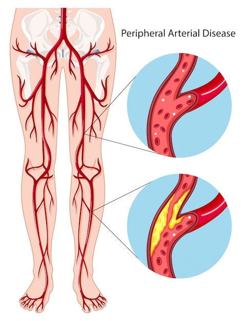 Diagrama de enfermedad arterial periférica