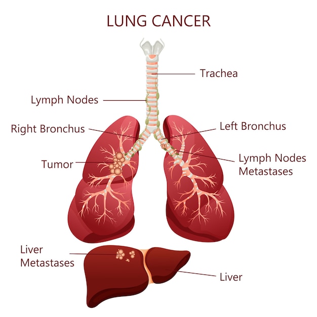 Diagrama enfermedad de cáncer de pulmón Concepto enfermedad órganos internos humanos Ilustración vectorial estilo de dibujos animados