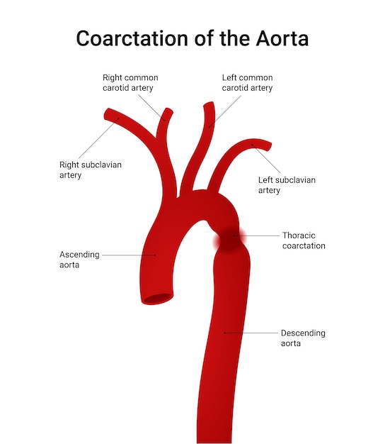 Diagrama esquemático de la coartación aórtica
