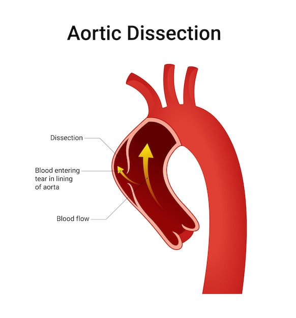 Diagrama esquemático de la disección aórtica