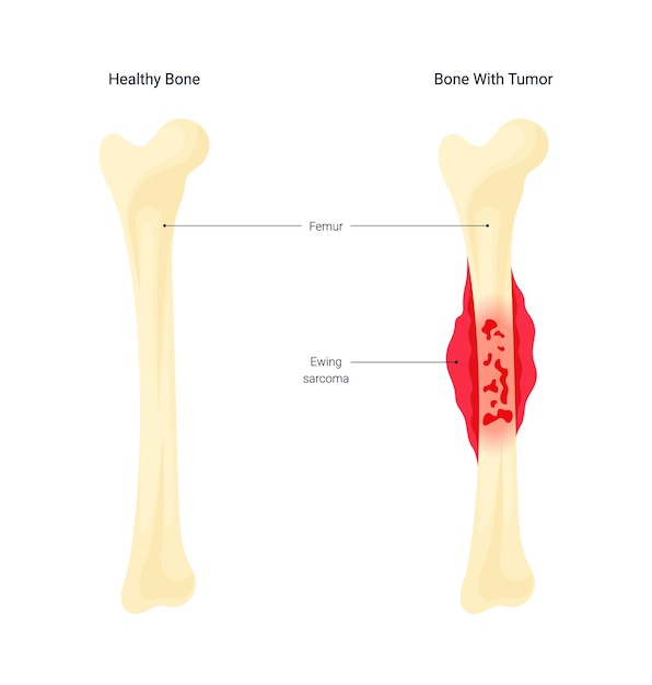 Vector diagrama ilustrativo de la enfermedad del cáncer óseo.