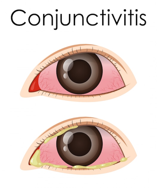 Vector diagrama mostrando conjuntivitis en humanos