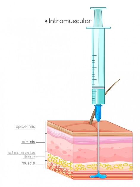 Vector diagrama que muestra la inyección intramuscular