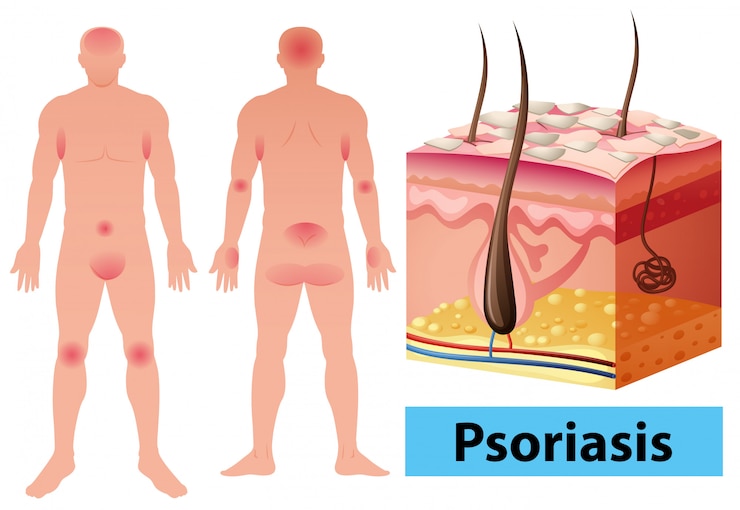 Vector diagrama que muestra la psoriasis en humanos