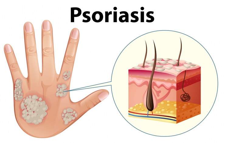 Vector diagrama que muestra la psoriasis en la mano humana