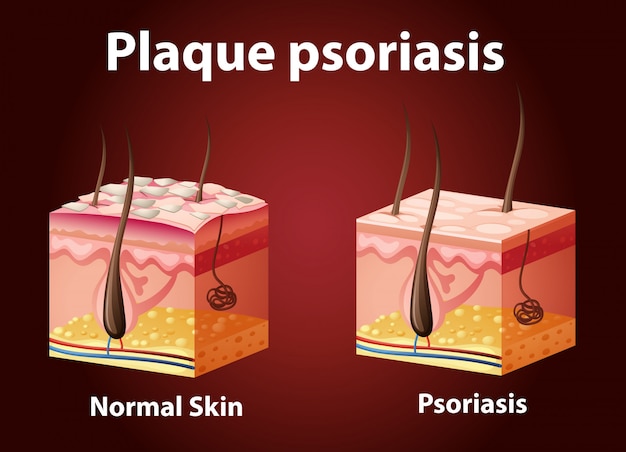 Diagrama que muestra la psoriasis en placas