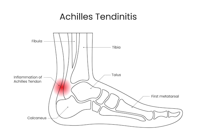 Diagrama de la tendinitis de Aquiles en estilo de línea