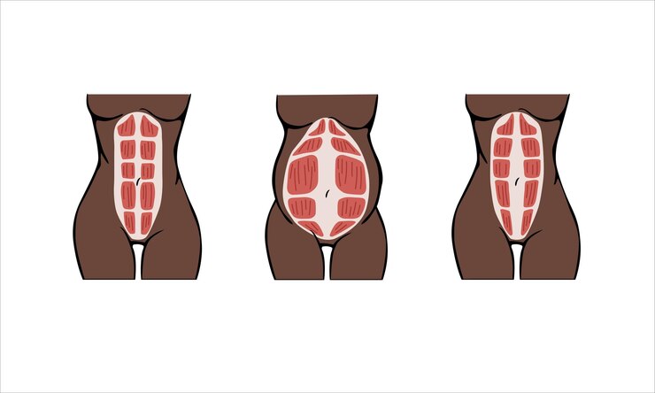 Vector diastasis de los niños