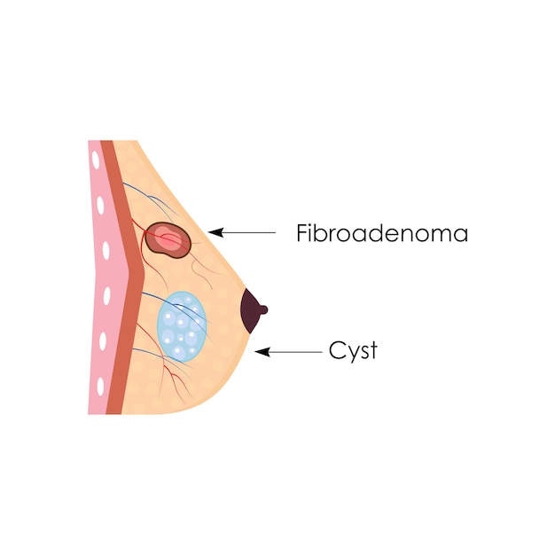 Vector dibujo anatómico mamas femeninas con tumores