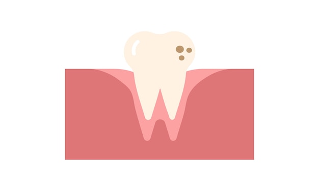 Diente con caries. La caries dental. Diente malo. Fondo de cuidado dental. Dientes no saludables. Diente vectorial
