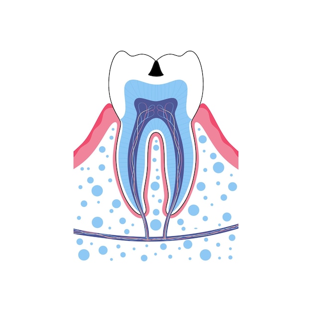 Diente con caries ilustración vectorial. cartel médico de la caries dental. consultorio de dentista, clínica de odontología