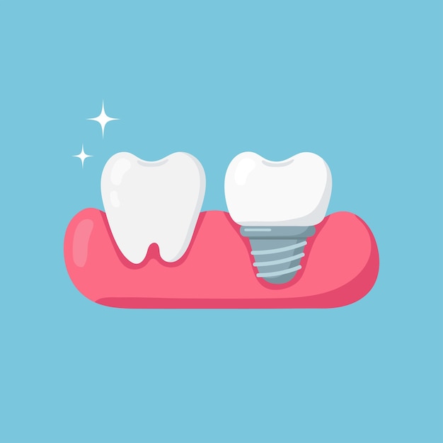 Vector diente e implante dental en fondo azul ilustración vectorial