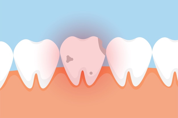 Diente malo que duele con un vector de efecto de brillo de peligro rojo Un vector de diente muerto con un efecto de brillo rojo Un diente muerto con caries vector de concepto de elementos de infografía dental Un diente con caries que duele