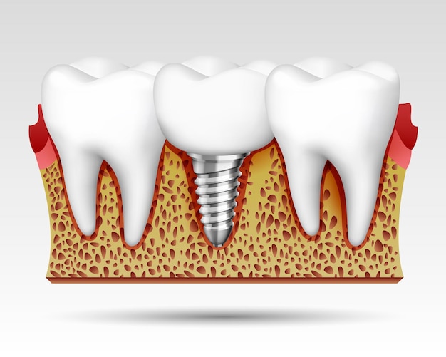 Vector dientes 3d en un corte con terminaciones nerviosas y con implante. ilustración vectorial