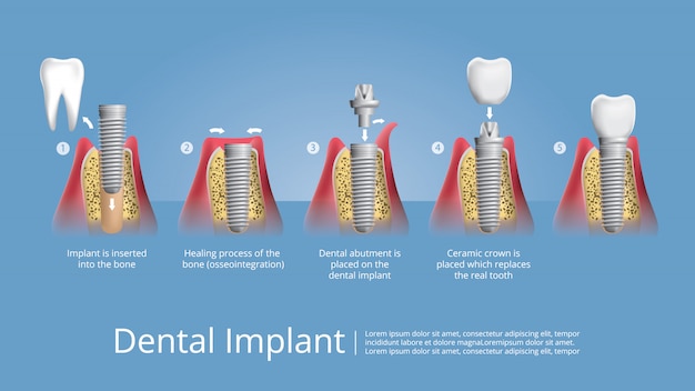 Vector dientes humanos e implante dental ilustración vectorial