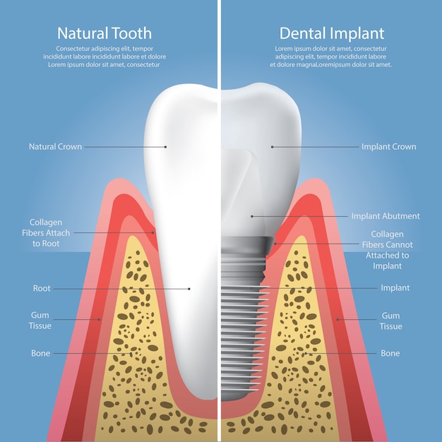 Dientes humanos e implantes dentales ilustración vectorial