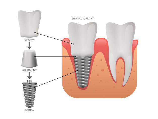 Vector dientes humanos e implantes dentales