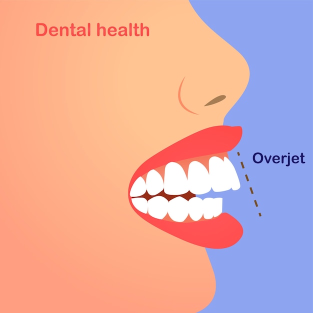 Vector dientes que sobresalen