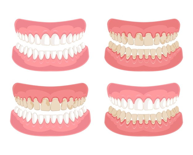 Dientes sanos y no saludables, sucios.