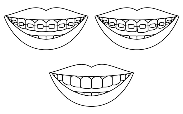 Dientes con soportes metálicos en odontología cosmética y ortodoncia dibujo de línea simple