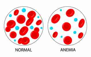 Vector la diferencia en la anemia es la cantidad de glóbulos rojos y la norma.