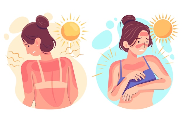 Diferentes personas con quemaduras solares.