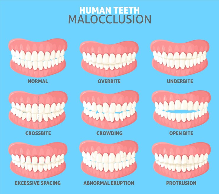 Vector diferentes tipos de maloclusión de los dientes humanos en vista delantera